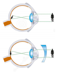 Astigmatismo